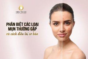 Distinguishing Common Types of Acne And Basic Treatment Advice