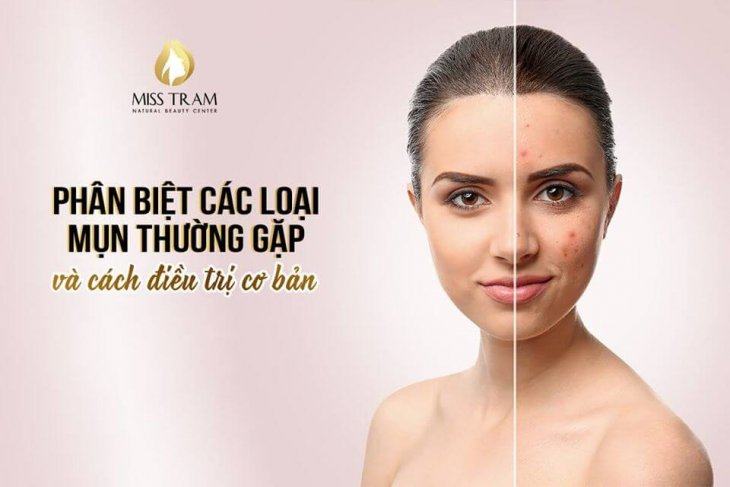 Phân Biệt Các Loại Mụn Thường Gặp Và Cách Điều Trị Cơ Bản