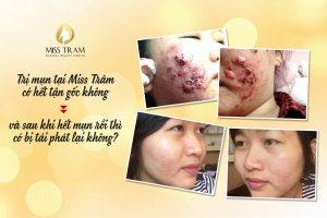 How to Treat Acne at the Root Without Recurrence Satisfied
