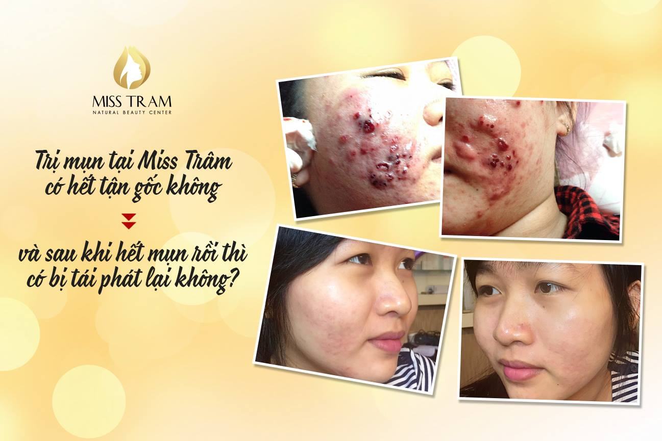 Safe acne treatment technology at Miss Tram