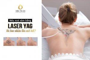 If Yag Laser Tattoo Removal, How Many Times Will It Be Announced