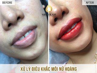 Xử Lý Điêu Khắc Môi Nữ Hoàng Cho Chị Lệ Biết ơn