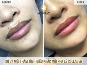Dark Lip Treatment And Ultimate Natural Collagen Crystal Lip Sculpting