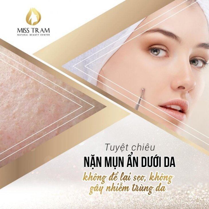 Nặn Mụn Ẩn Dưới Da Không Để Lại Sẹo, Không Gây Nhiễm Trùng Da