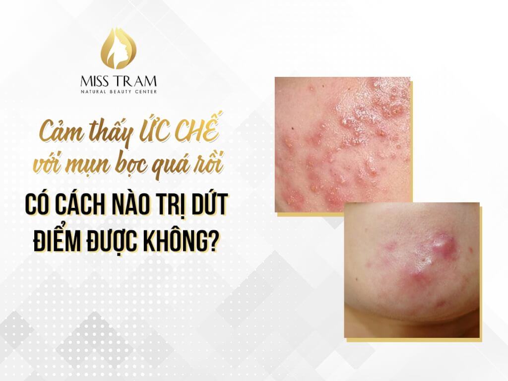Is there a way to permanently treat acne? Information