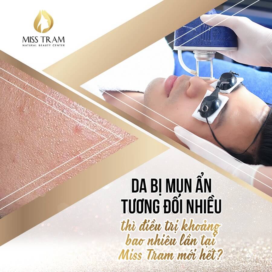 Da Bị Mụn Ẩn Tương Đối Nhiều Thì Điều Trị Bao Nhiêu Lần Mới Hết Nhấn mạnh