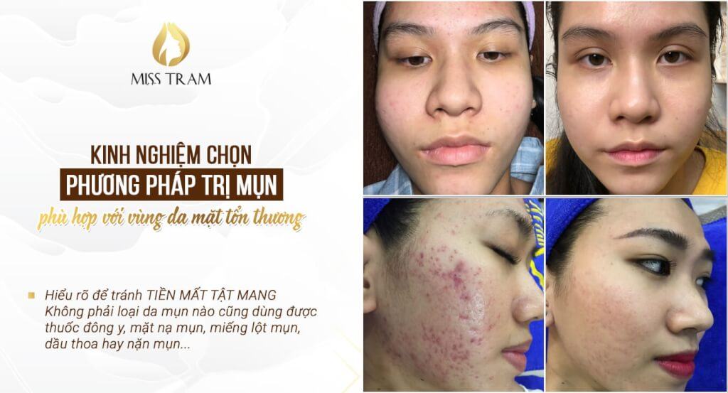 Safe acne treatment results at Miss Tram