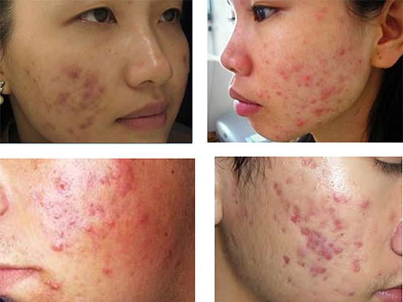 Instructions for Squeezing Pimples, Pimples Safely At Home Results