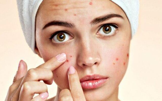 Acne causes damage to the skin of the face