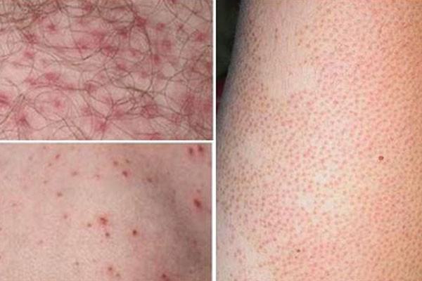 Effective home treatment for pore inflammation