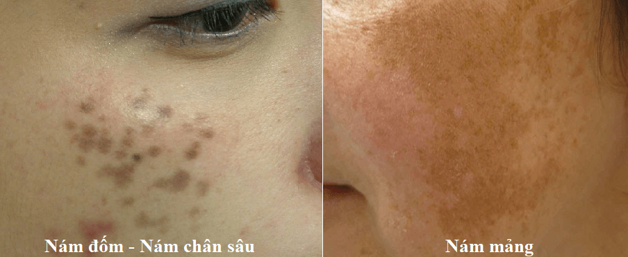 Remove Melasma, Treat Freckles at the Root Safely, Consultancy Guarantee