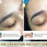 Điêu Khắc Chân Mày Khắc Phục Khuyết Điểm Sẹo Cho Chị Băng Nghiên cứu