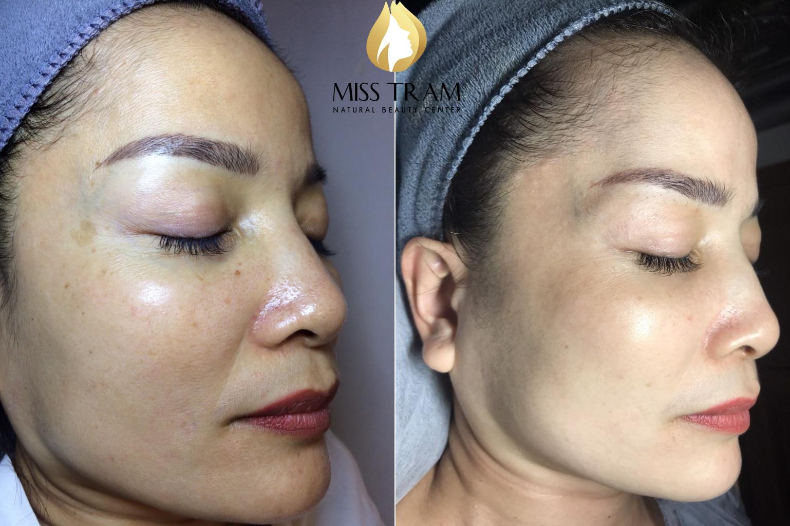 Melasma Treatment Results Before And After At Miss Tram Spa