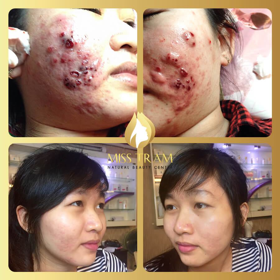 Scar Treatment Service - Long-term Pimples Miss Tram Tips