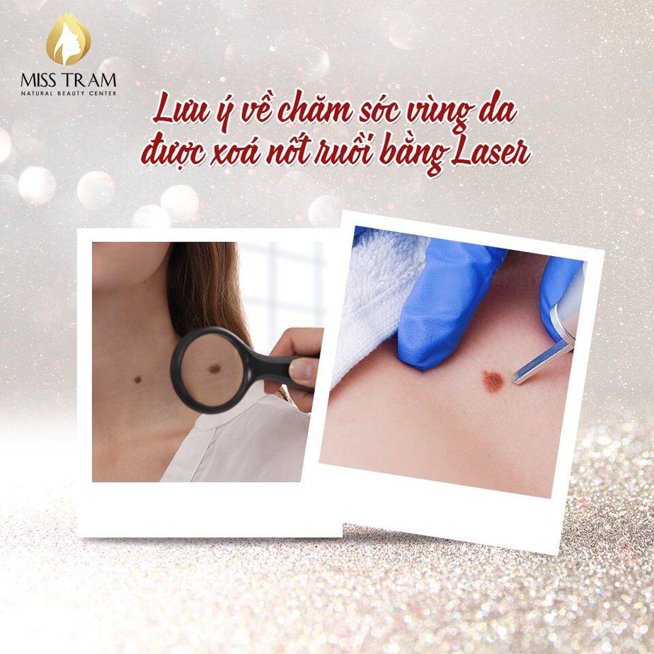 How To Take Care Of The Skin To Be Removed With Laser Mole Open Eyes