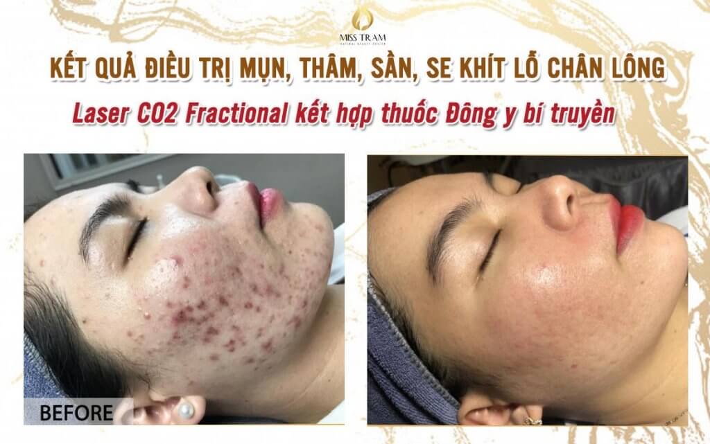 CO2 Fractional Fractional Laser Treatment of Acne and Pore Tightening Results Combined with Sincerely Traditional Oriental Medicine