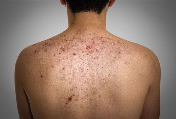 Causes of back acne in men