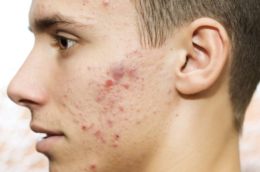 Top 6 Bad Habits That Make Men's Skin Easily Acne Tips