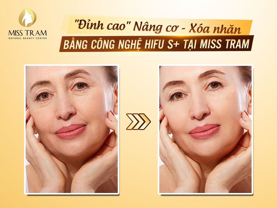 Face lifting, wrinkle removal with Hifu S + technology