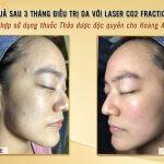Kết Quả Điều Trị Da Với Laser CO2 Fractional Kết Hợp Thảo Dược Độc Quyền Nghiên cứu