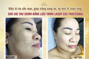 Đẩy Lùi Sần Mụn, Thâm Nám, Trẻ Hóa Da Với Liệu Trình Laser Co2 Fractional Mở mắt