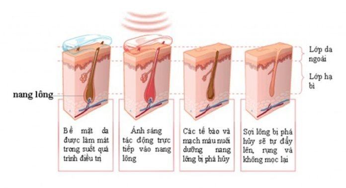 Dịch Vụ Tẩy Lông, Triệt Lông An Toàn Tại TPHCM Báo cáo