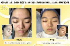 Kết Quả Sau 3 Tháng Điều Trị Da Với Laser CO2 Fractional Cho Nữ Phổ biến