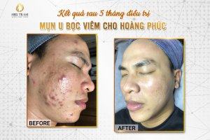 Kết Quả Điều Trị Da Mụn U Bọc Viêm 5 Tháng Cho Nam Tin tức