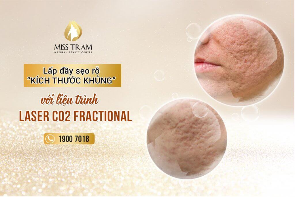 How To Treat Pore Scars Effectively With Fractional CO2 Laser Treatment