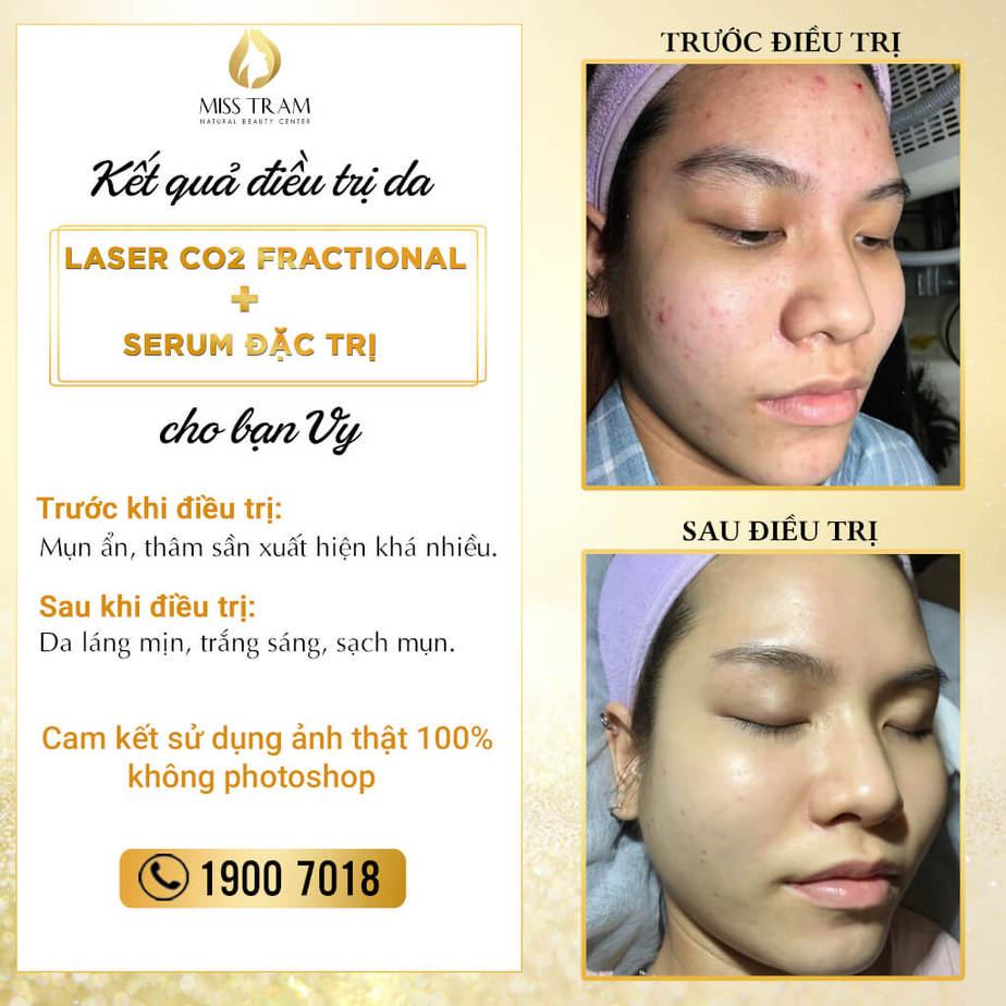 Fractional CO2 Laser Skin Treatment Results + Special Treatment Serum Rules