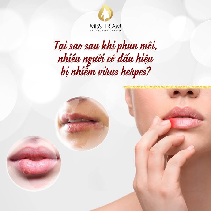 Learn About Herpes Virus Infection When Spraying Lips Remember