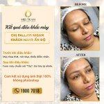 Ảnh Kết Quả Điêu Khắc Mày Cho Chị Pallavi Nigam Nghiên cứu