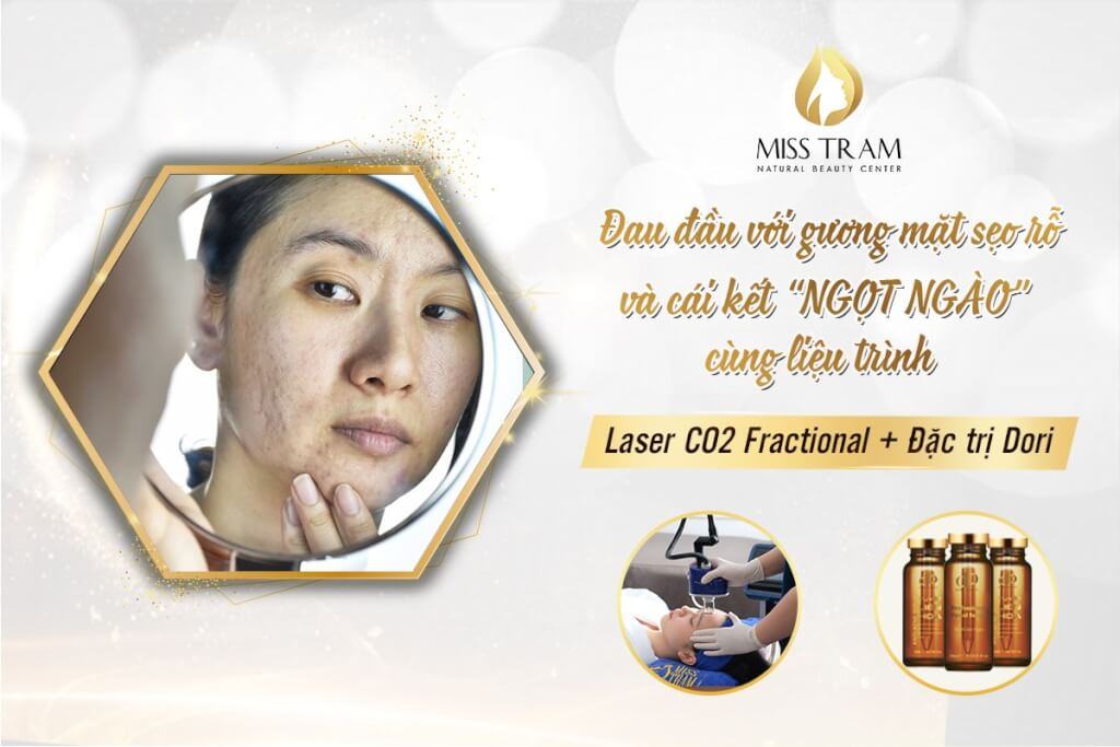 Trị sẹo rỗ an toàn với liệu trình laser co2 fractional + đặc trị Dori