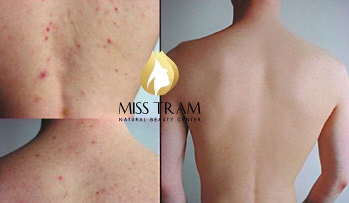 Address to treat back acne in Ho Chi Minh City