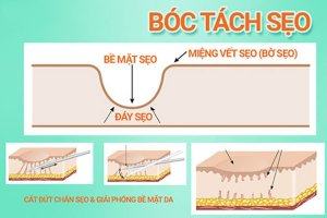 Hướng Dẫn Chăm Sóc Da Sau Khi Bóc Tách Sẹo Phổ biến