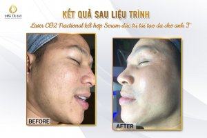 Kết Quả Liệu Trình Laser Co2 Fractional Kết Hợp Serum Tái Tạo Da Tin tức