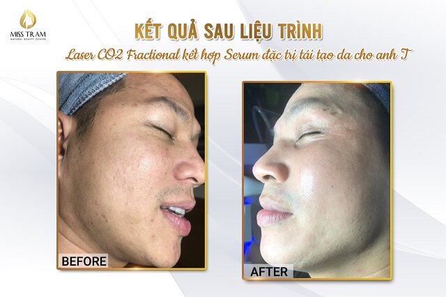 Kết Quả Liệu Trình Laser Co2 Fractional Kết Hợp Serum Tái Tạo Da Nhấn mạnh