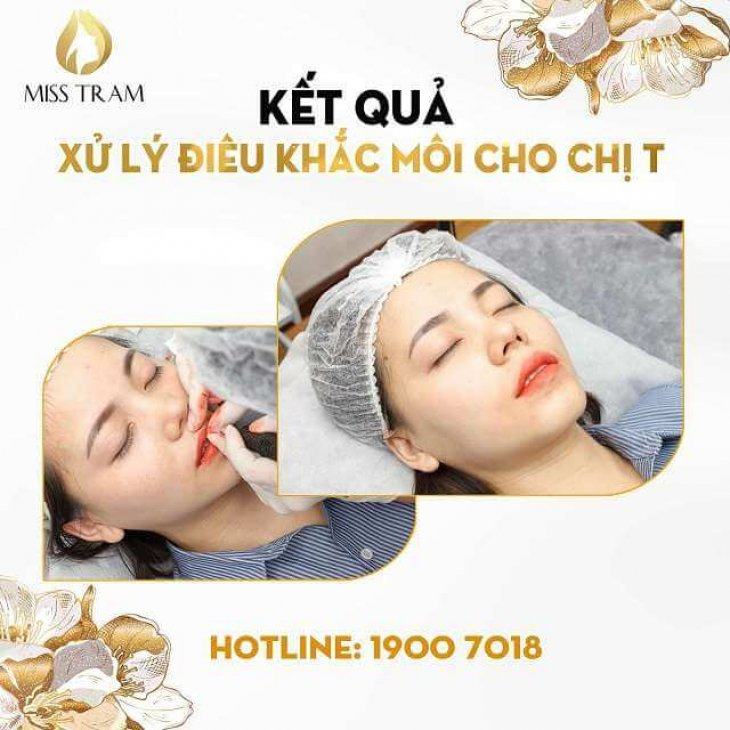 Trước & Sau Xử Lý Điêu Khắc Môi Cho Chị Thanh Không Sưng