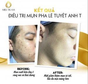 Before & After The Snow Crystal Acne Treatment Result For You Toan Need To Know