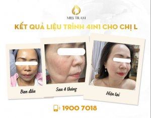 Trước & Sau Kết Quả Liệu Trình 4in1 Trị Sạm, Nám Da Cho Chị Linh Cần biết