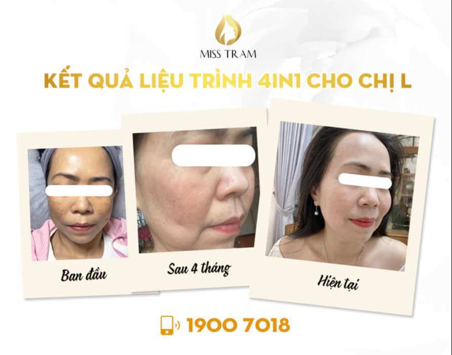 Trước & Sau Kết Quả Liệu Trình 4in1 Trị Sạm, Nám Da Cho Chị Linh Điều chưa biết