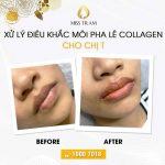 Kết quả bất ngờ trước và sau điêu khắc môi collagen