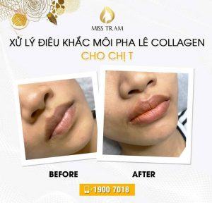 Surprising results before and after collagen lip sculpting