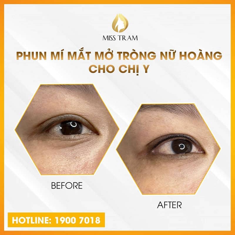 Sự khác biệt trước và sau phun mí mở tròng