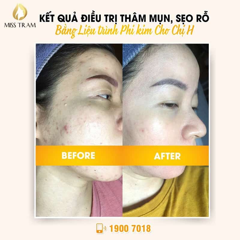 The results of using the non-treatment process even acne, pitted scars