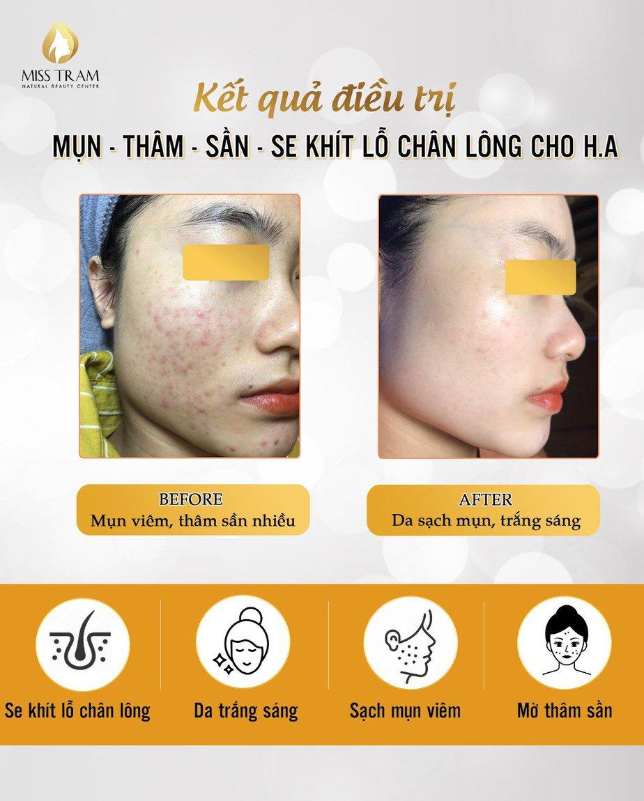 Miss Tram - Natural Beauty Center: 20 kinh nghiệm điều trị mụn tại HCM