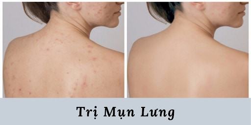 spa trị mụn lưng an toàn quận 4 hcm