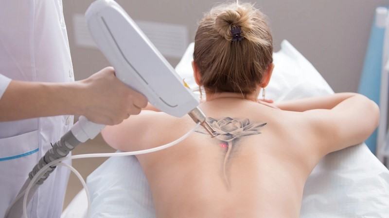 Tattoo Removal Service Without Scars