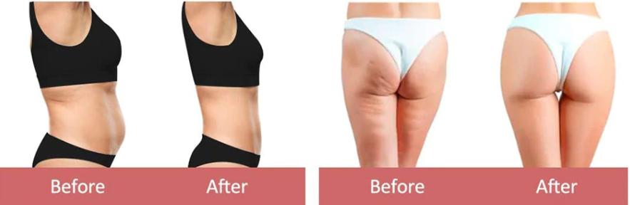 XbodyFit process - Lose fat, tighten your appearance without waiting for weight loss Should see