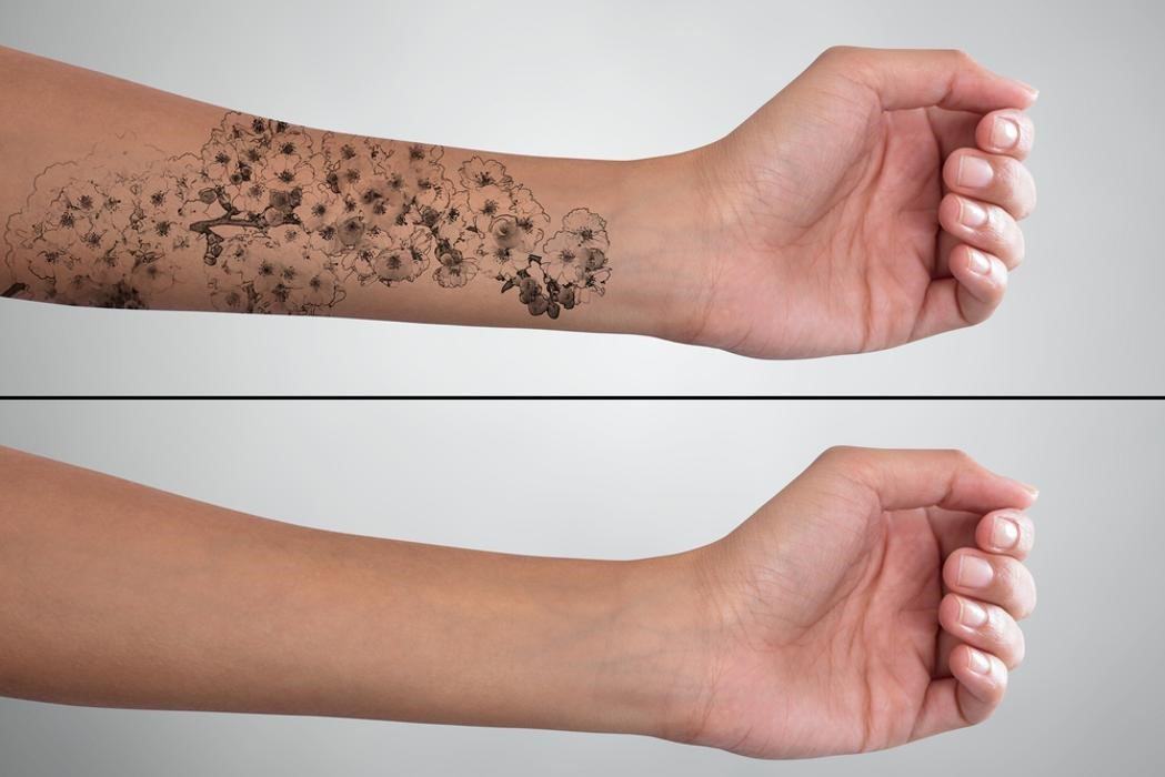 Before and after tattoo removal pictures